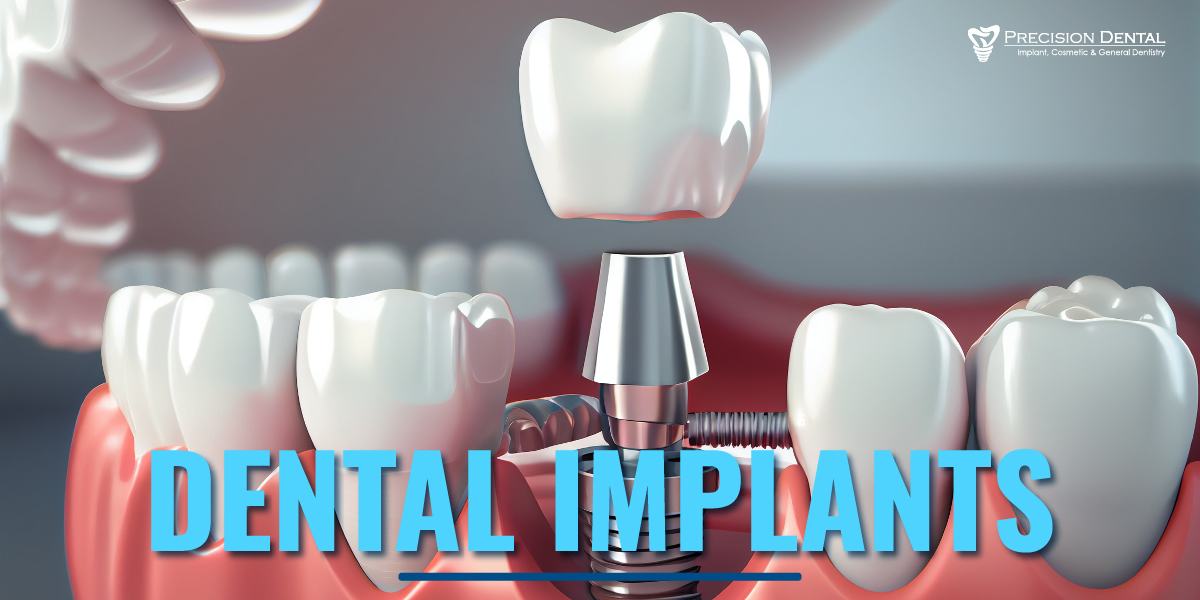 Caring For Your Temporary Dental Filling - My Dentist Burbank