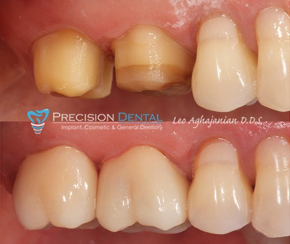 molar crown before after