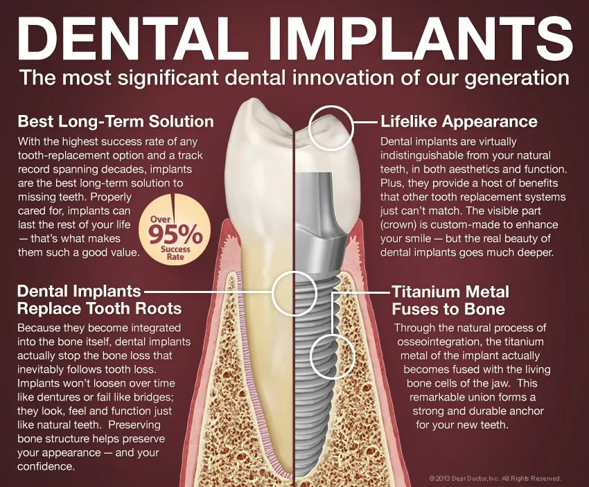 Dental Implants: The most significant dental innovation of our generation